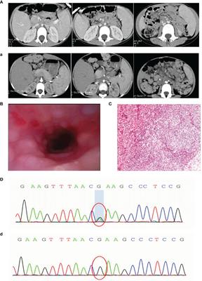 Case Report: First Occurrence of Plasmablastic Lymphoma in Activated Phosphoinositide 3-Kinase δ Syndrome